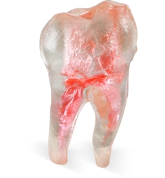 Endo 3DP™#31 Accessed Molar (LR7)